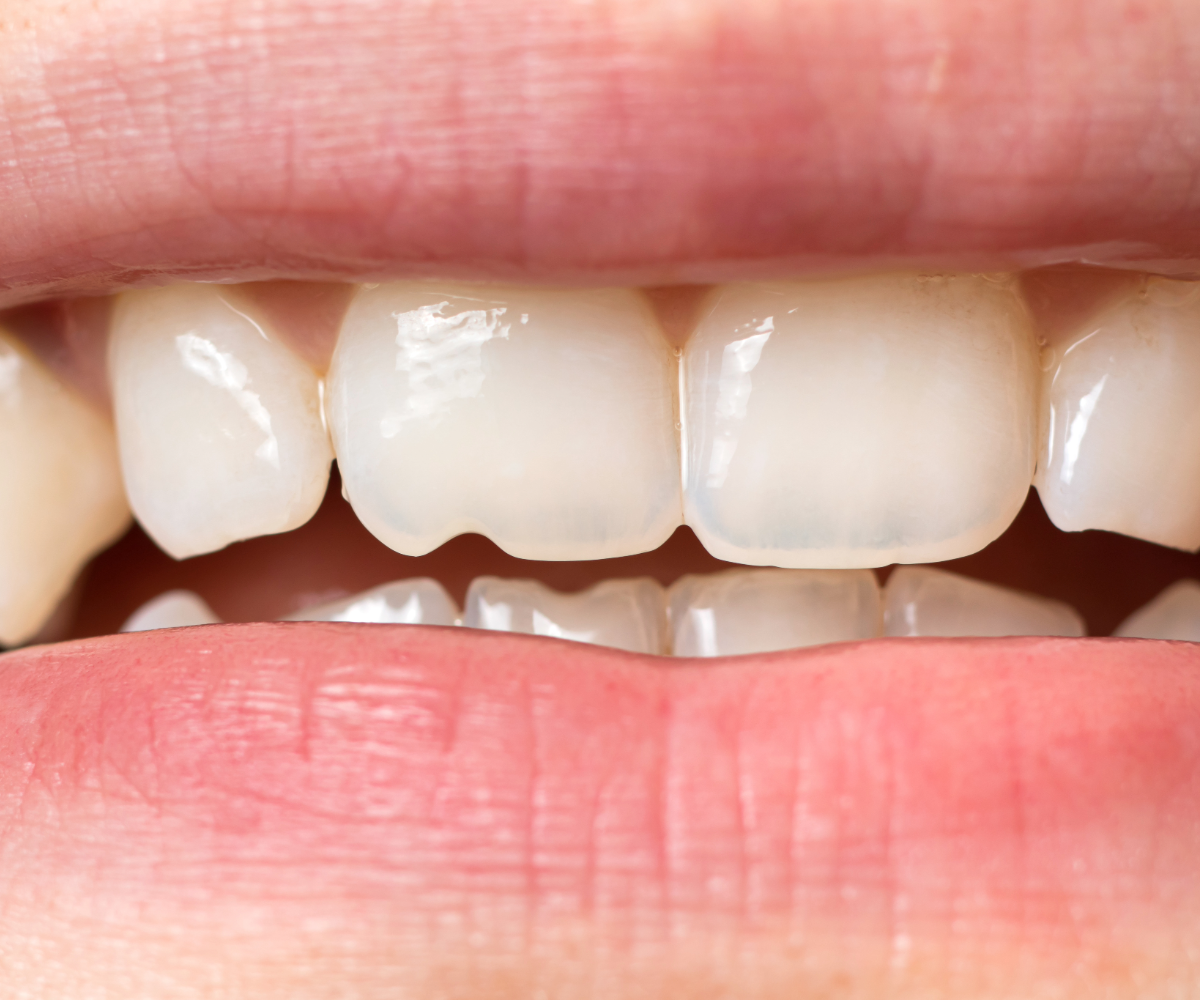 Worn down teeth