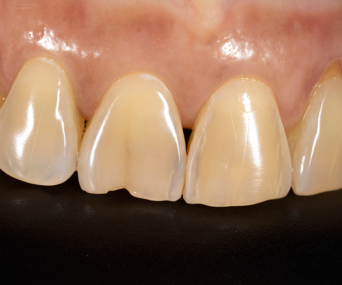 Chipped tooth repair