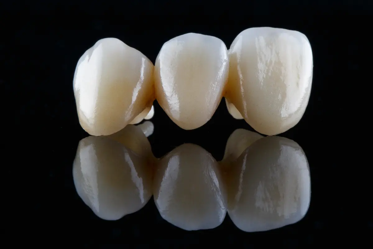 Dental bridges