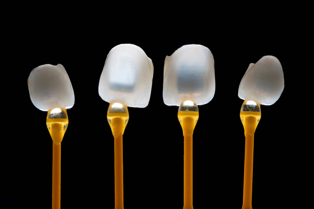 Veneers at Face Dental, Coventry