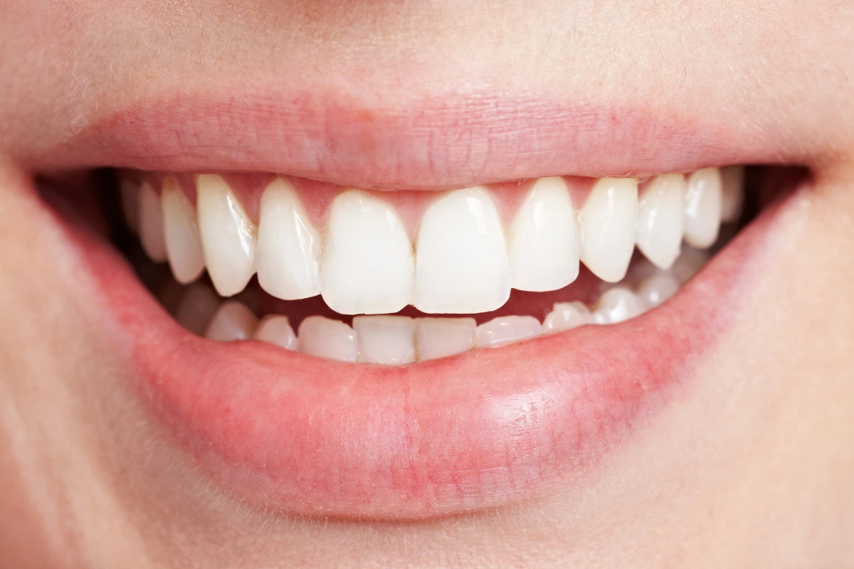 Full smile makeover