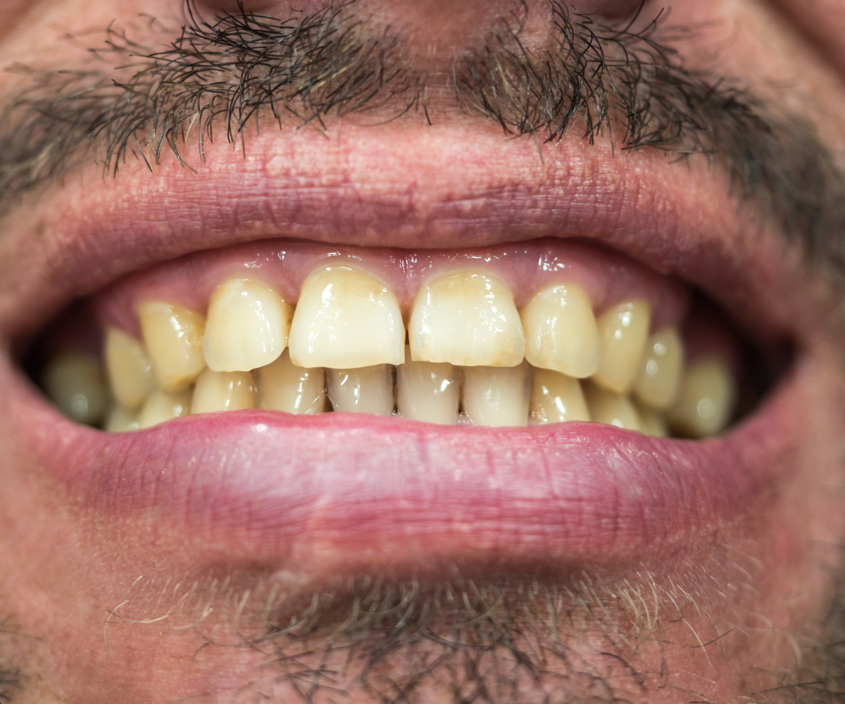Reshaping uneven teeth