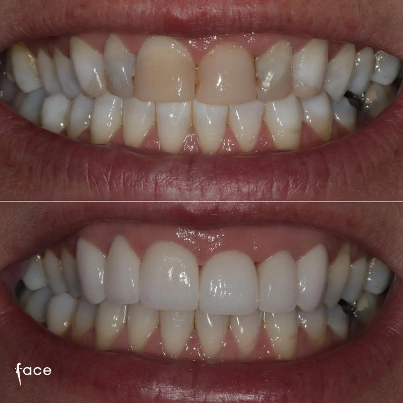 Emax dental crowns