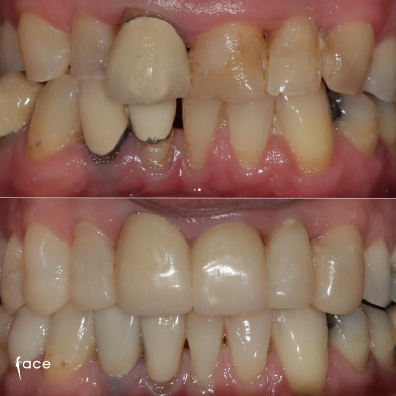 Complete smile makeover