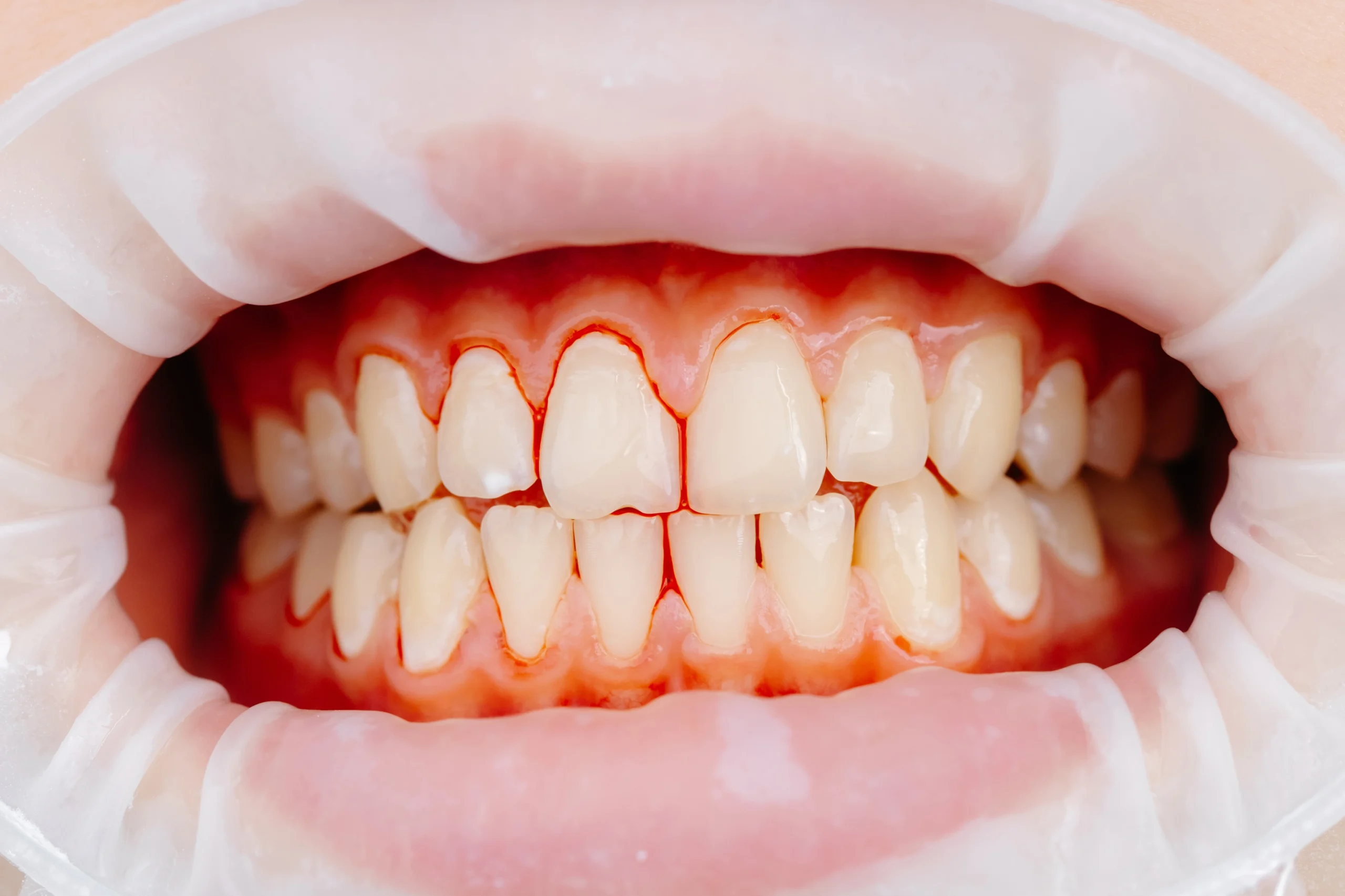 Bleeding gums