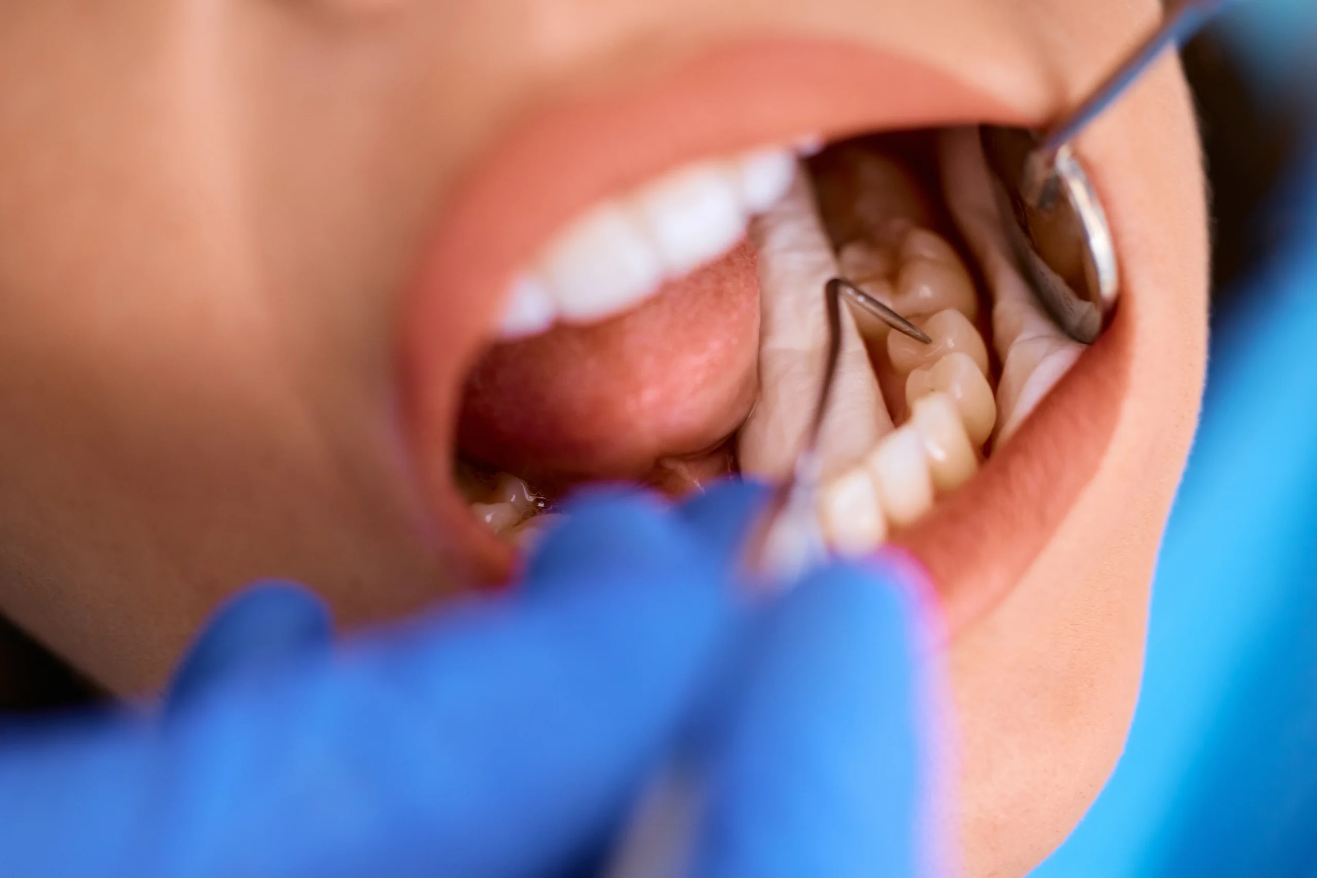Existing restorations