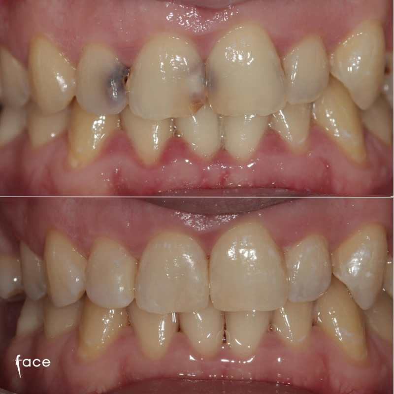 Composite bonding results