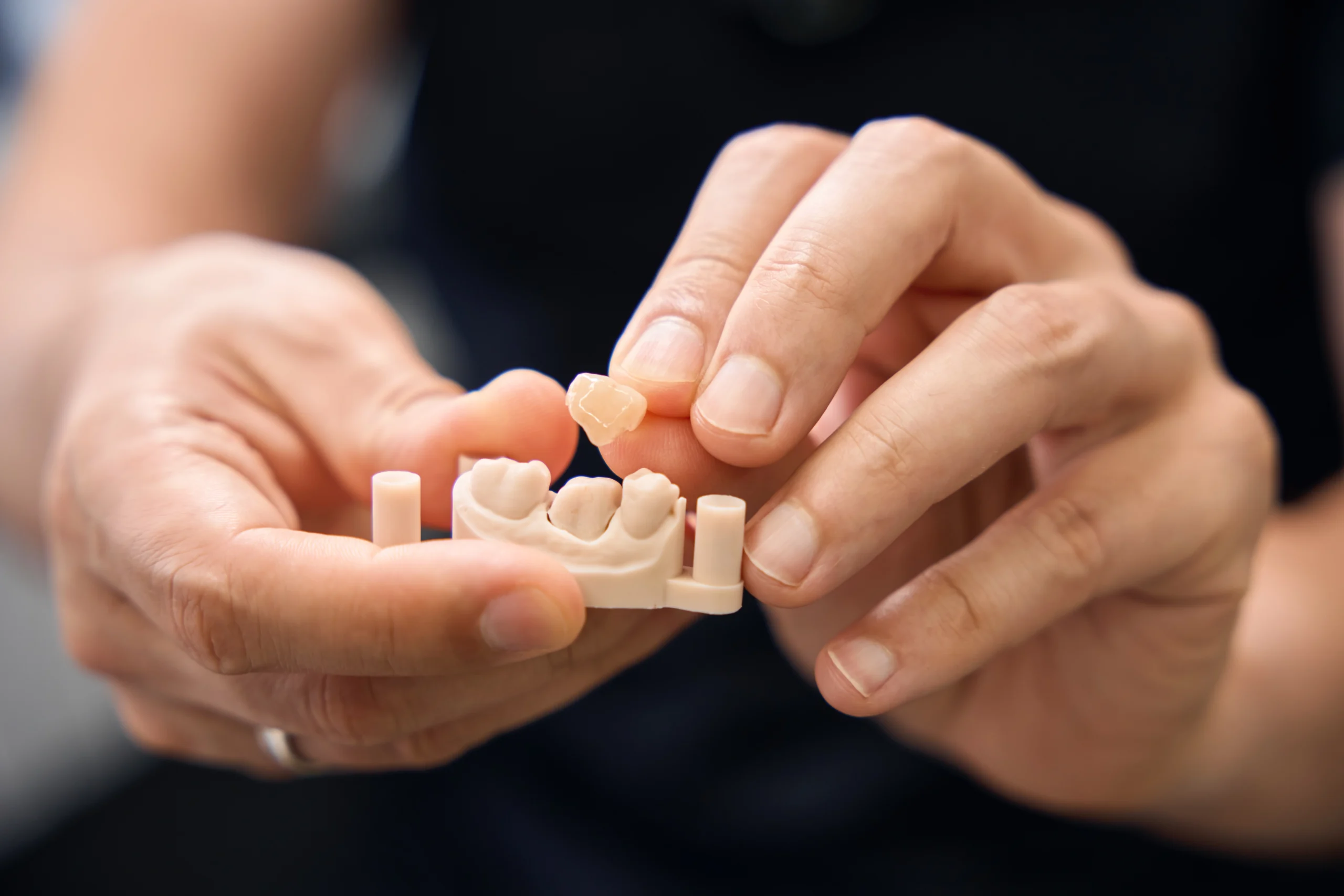 Dental crowns at Face Dental