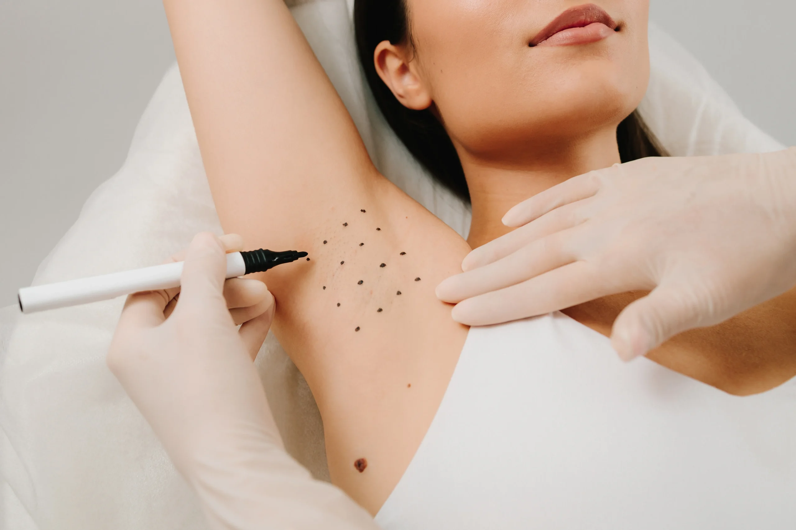 Hyperhidrosis treatment at Face Dental Coventry