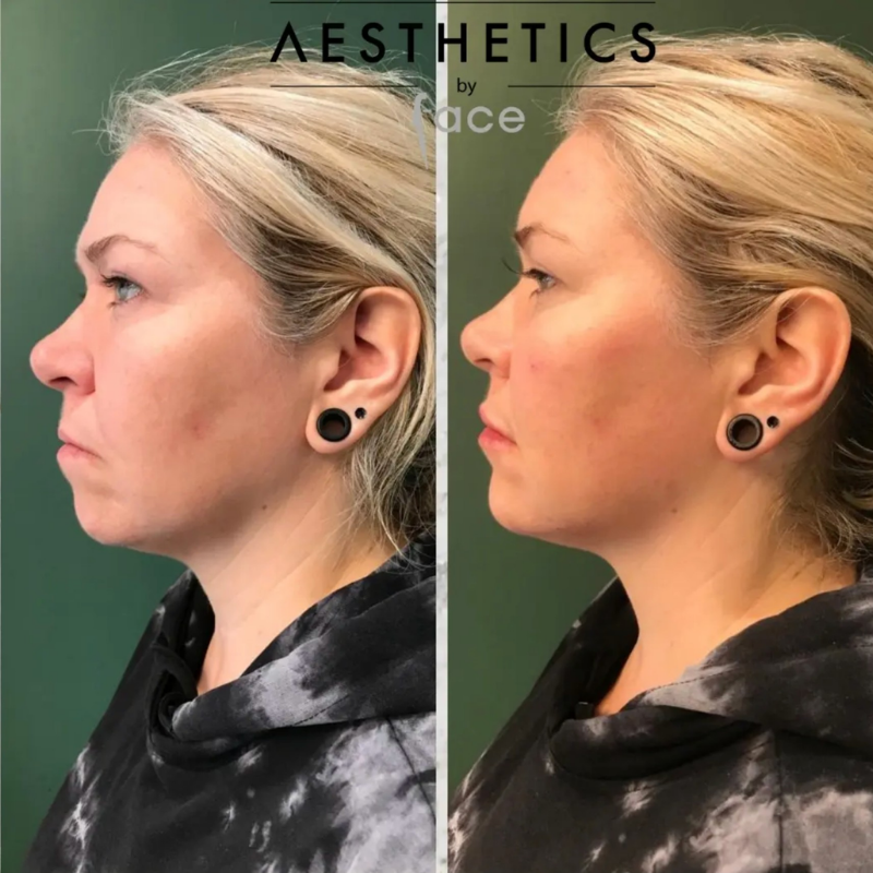 Dermal filler results