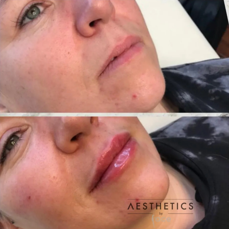 Lip filler transformation