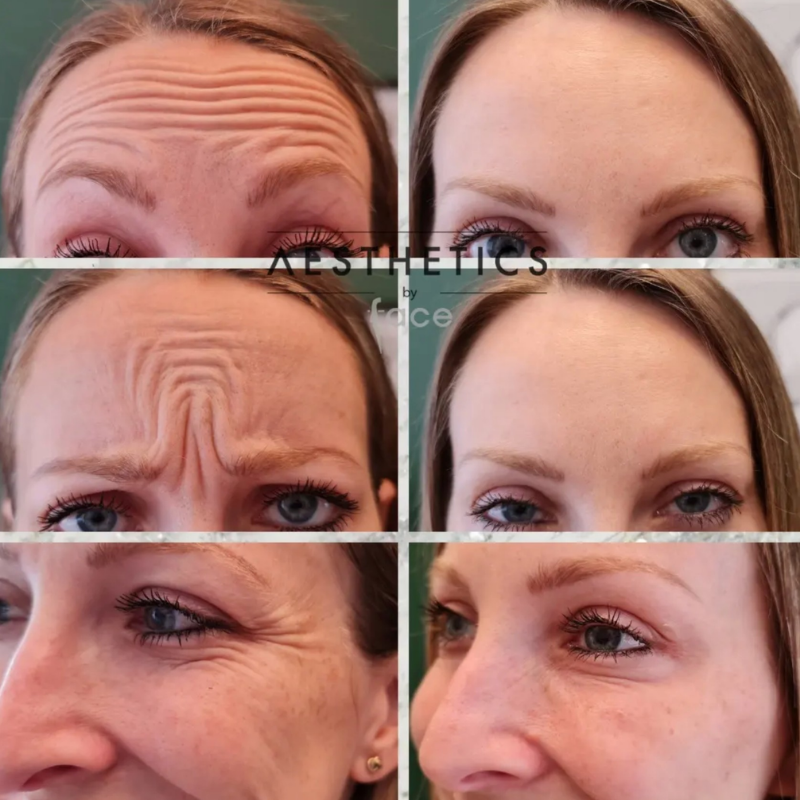 Facial contouring results