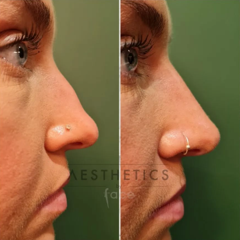 Facial rejuvenation
