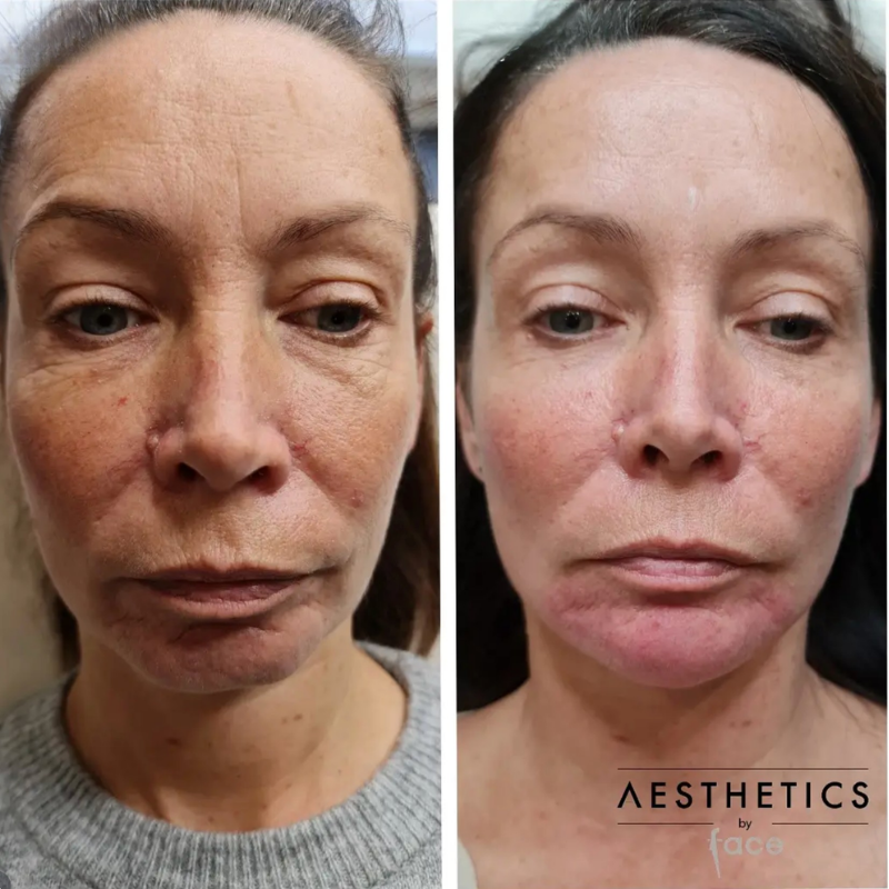 Dermal filler before after