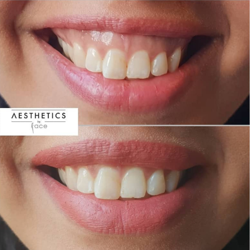 Facial volume restoration