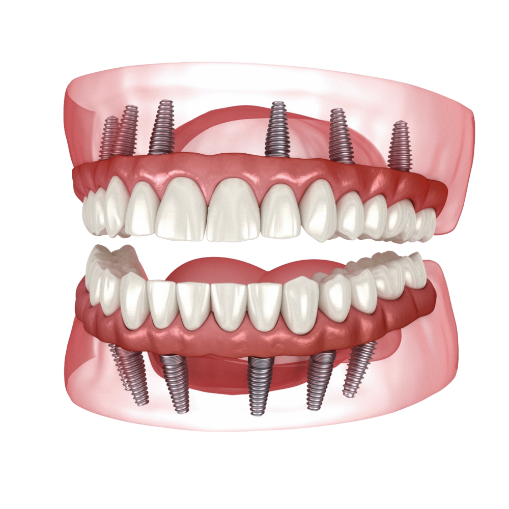 Full mouth restoration with dental implants