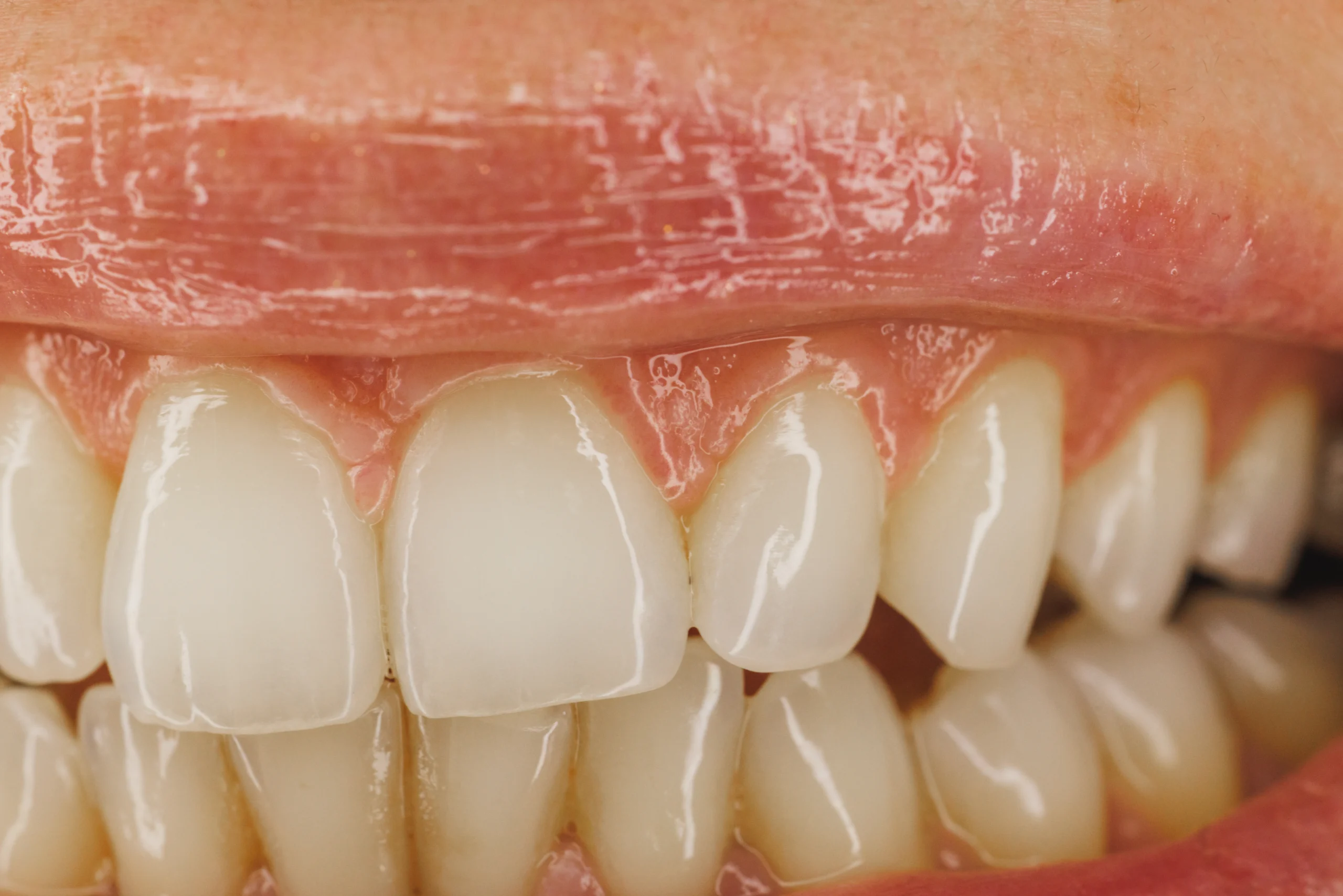 Gum disease treatment at Face Dental, Coventry