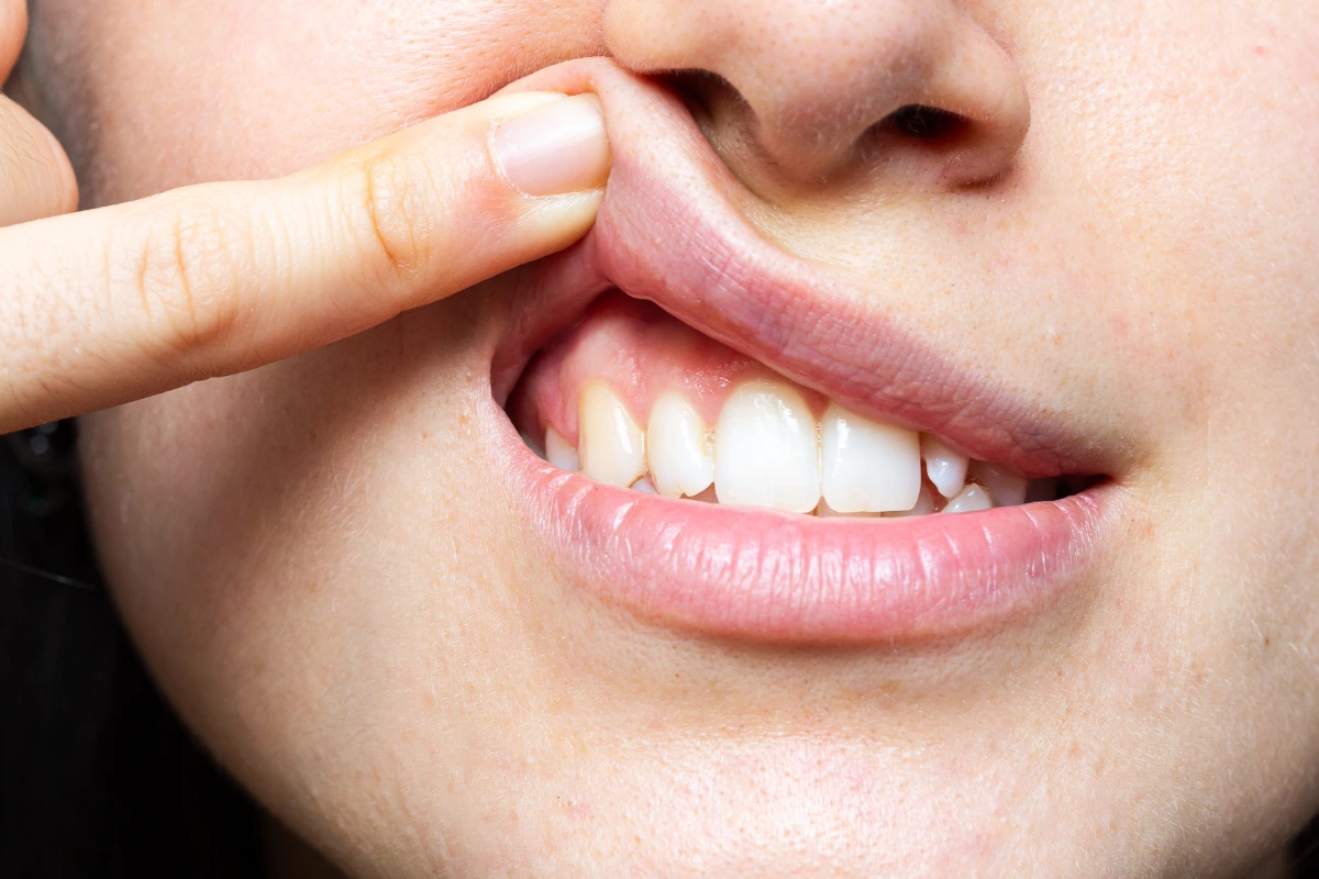 Early gum disease detection
