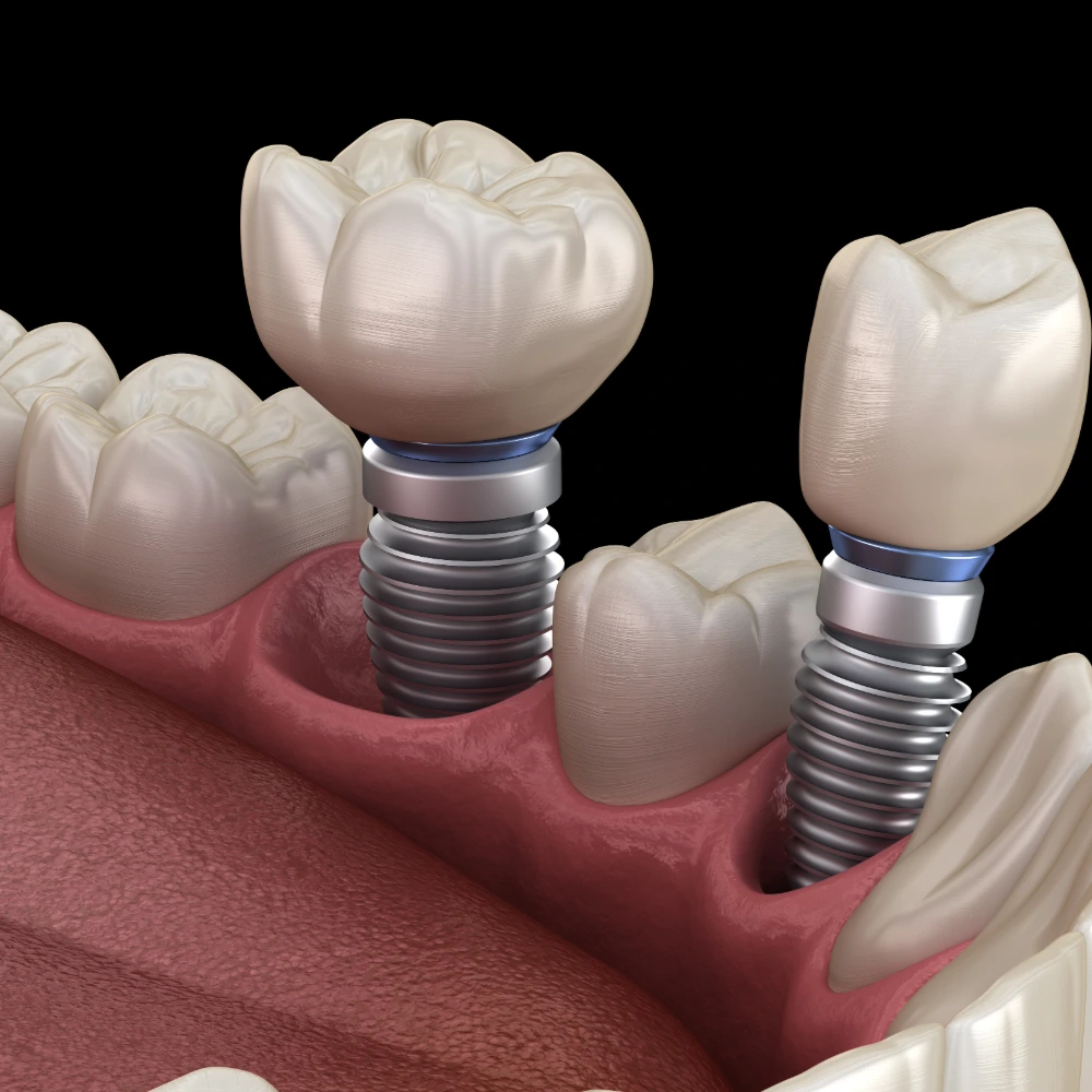 Implant placement