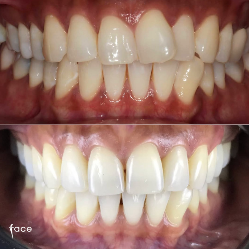 Invisalign & whitening