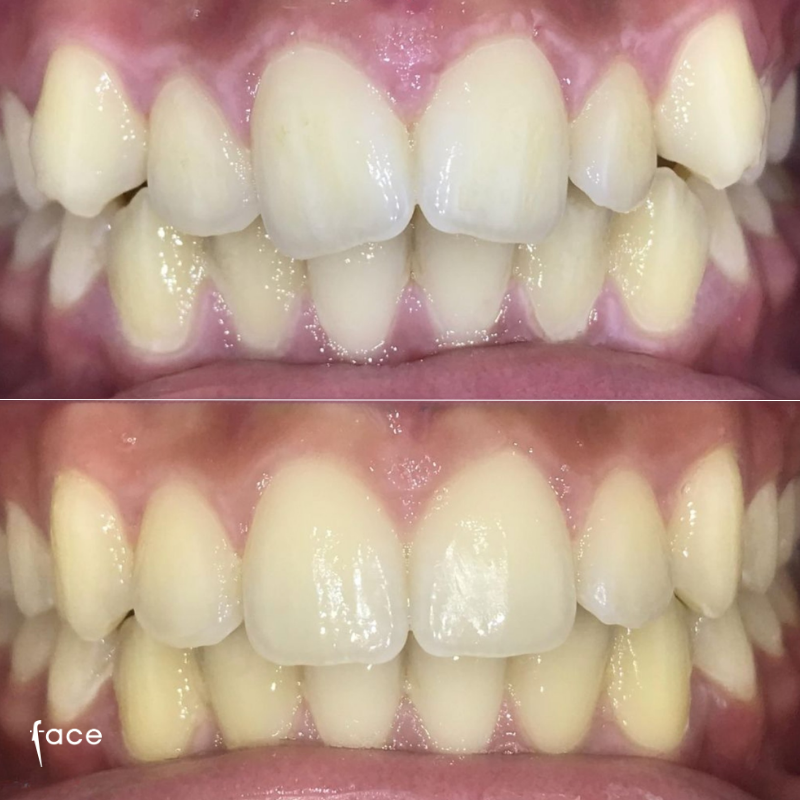 Invisalign transformation