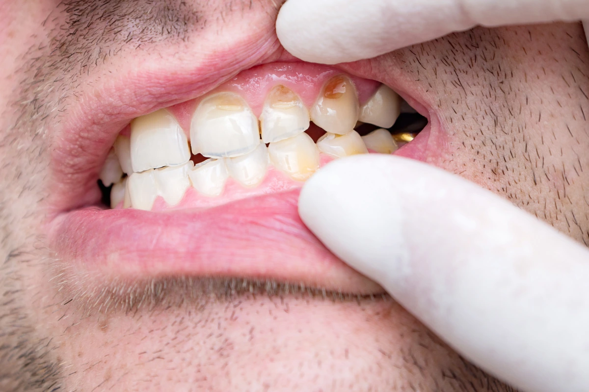 Loose or shifting teeth