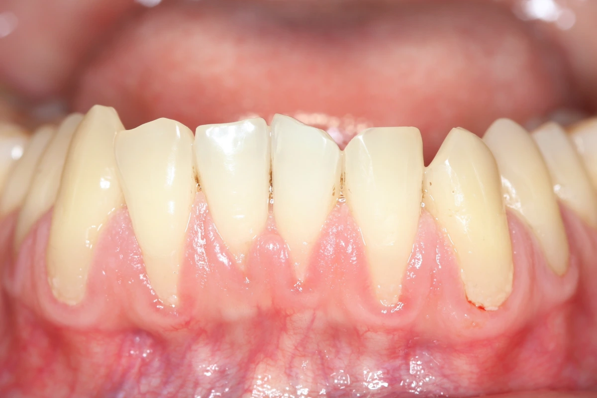 Receding gums