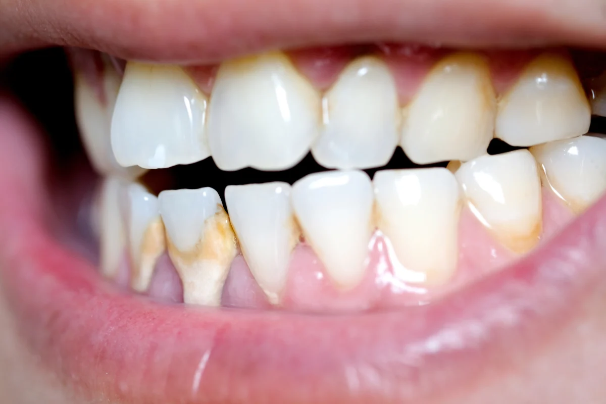 Tartar removal