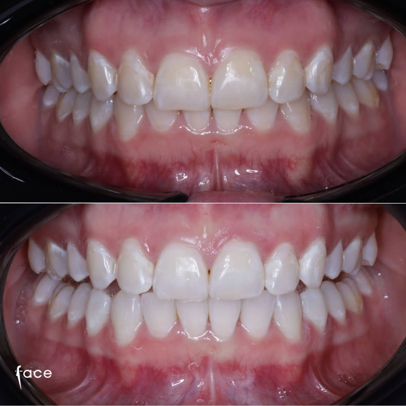 Teeth whitening results