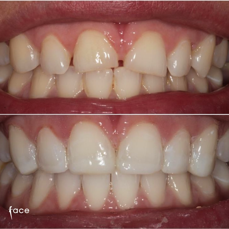 Whitening & composite bonding
