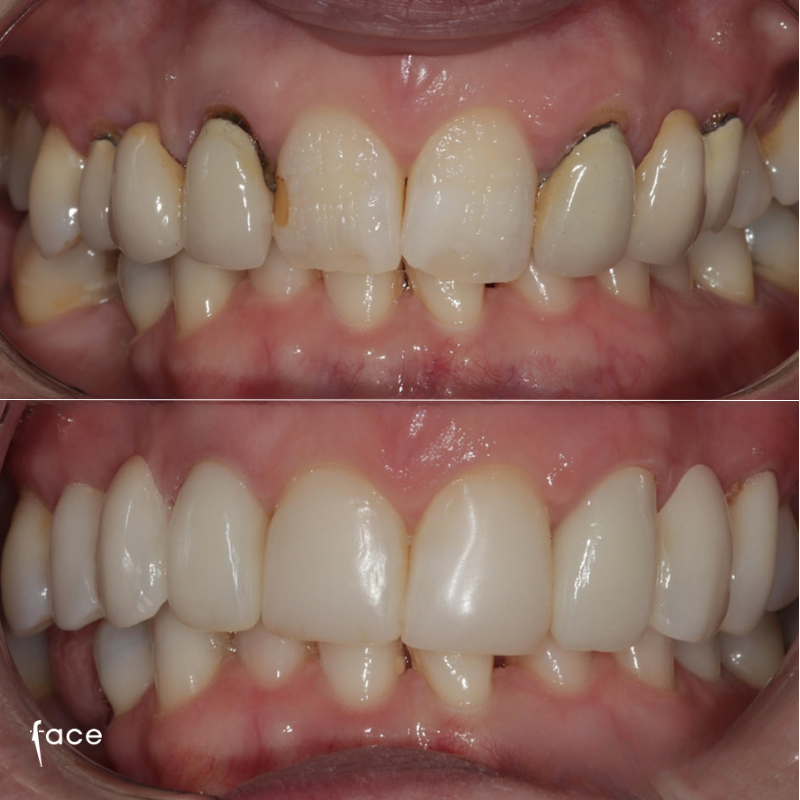 Whitening, bonding & crowns