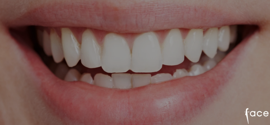 what is composite bonding - blog cover photo