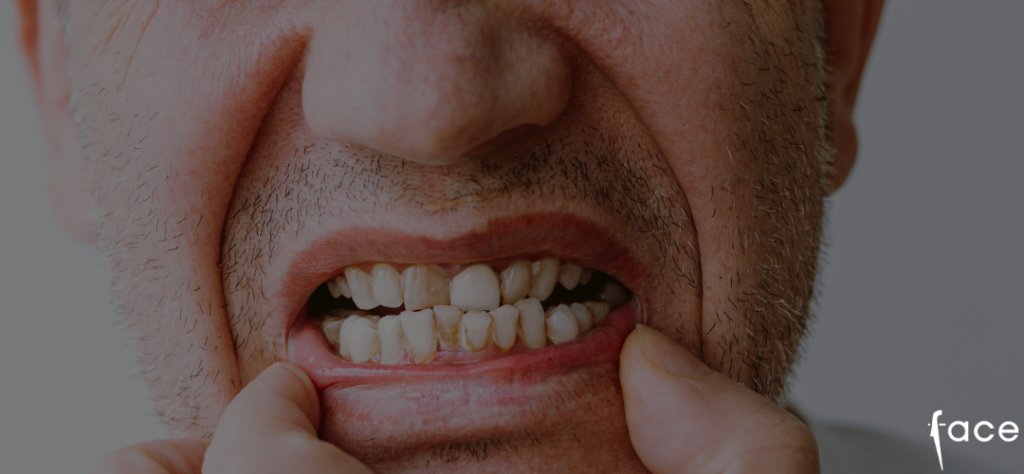 how to remove tartar from teeth - photo with tartar blog